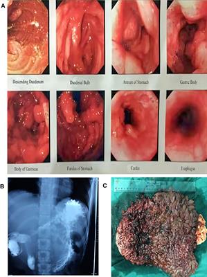 Diffuse benign inflammatory gastric polyps: A rare case in a young female: Case report and review of the literature